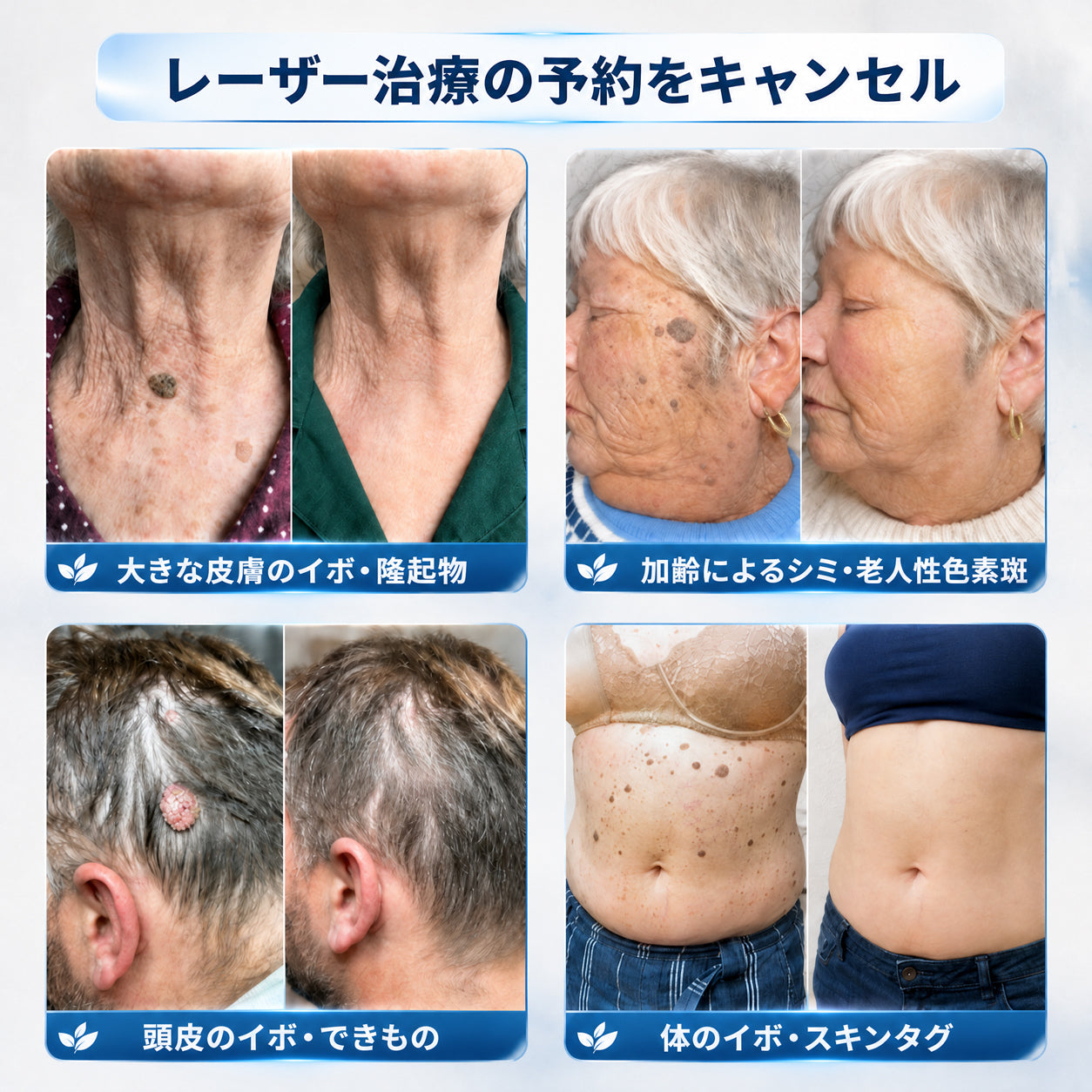 薬剤師もおすすめ💕 Hiskin® 7日間 タグ＆スポットイレーサー🪄 （痛みゼロ・傷あとゼロを目指すローラーボールタイプ）👩‍⚕️（副本）