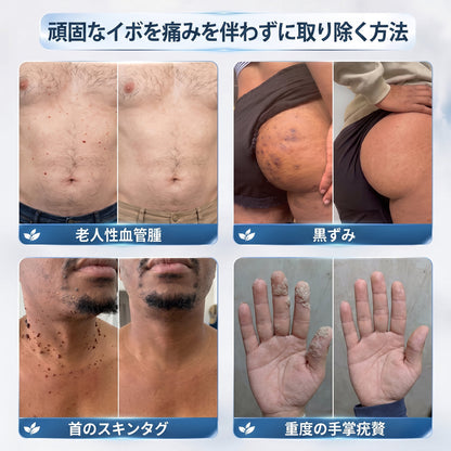 薬剤師もおすすめ💕 Hiskin® 7日間 タグ＆スポットイレーサー🪄 （痛みゼロ・傷あとゼロを目指すローラーボールタイプ）👩‍⚕️（副本）