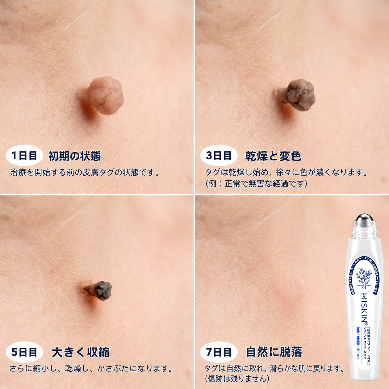 薬剤師もおすすめ💕 Hiskin® 7日間 タグ＆スポットイレーサー🪄 （痛みゼロ・傷あとゼロを目指すローラーボールタイプ）👩‍⚕️（副本）