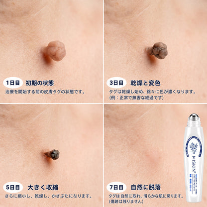薬剤師もおすすめ💕 Hiskin® 7日間 タグ＆スポットイレーサー🪄 （痛みゼロ・傷あとゼロを目指すローラーボールタイプ）👩‍⚕️（副本）