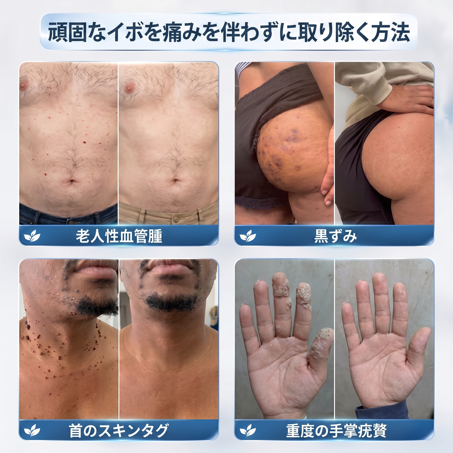 🎮薬剤師もおすすめ HISKIN® 7日間 タグ＆スポットイレーサー🪄 （痛みゼロ・傷あとゼロを目指すローラーボールタイプ）👩‍⚕️