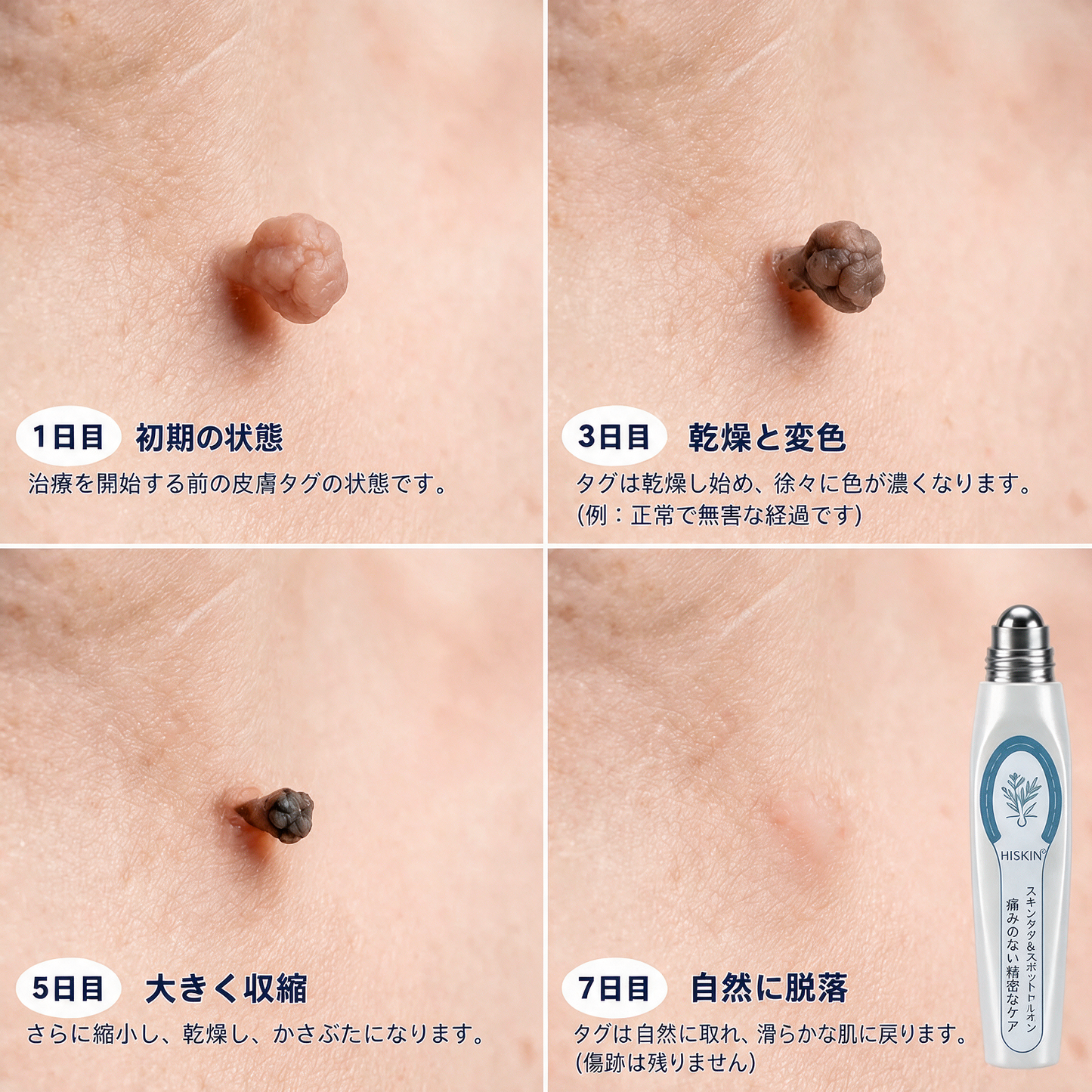 🎮薬剤師もおすすめ HISKIN® 7日間 タグ＆スポットイレーサー🪄 （痛みゼロ・傷あとゼロを目指すローラーボールタイプ）👩‍⚕️